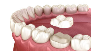 Dental Tooth Crown Procedure In Houston, Tx