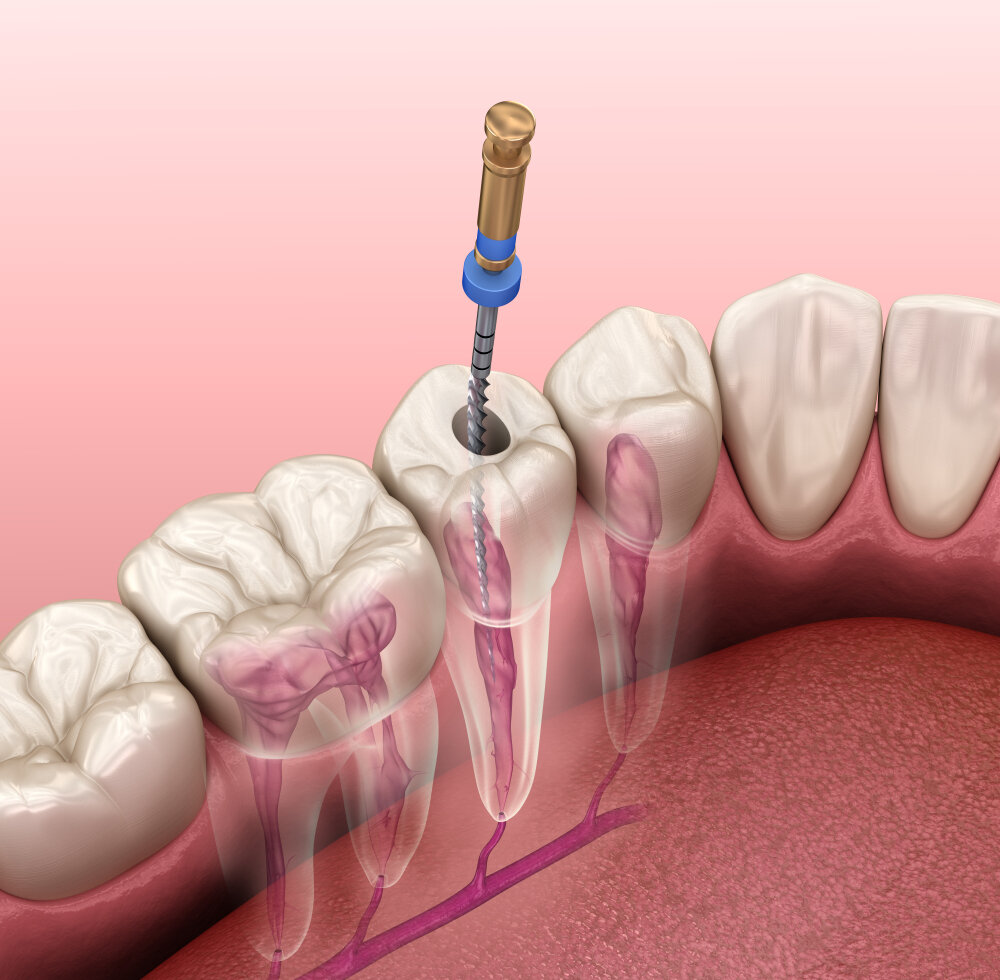 Root Canal Specialist Near Me | Root Canal Treatment Procedure
