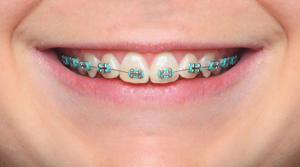 What Are The Best Braces Colors?