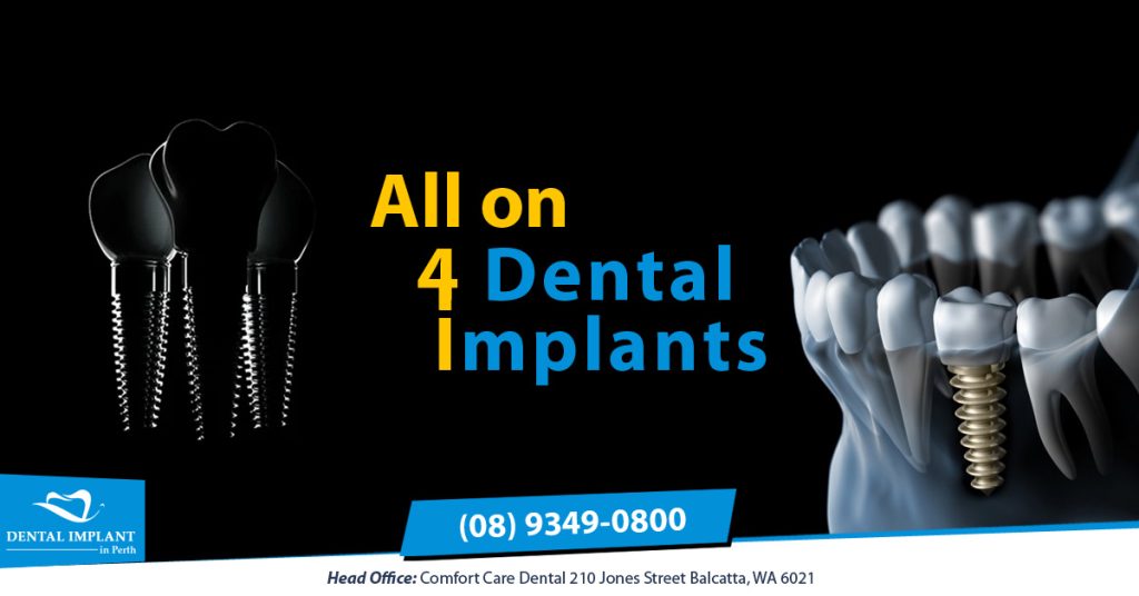 Low cost all on 4 dental implants in Perth - Dental Implants in Perth