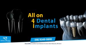 Low cost all on 4 dental implants in Perth – Dental Implants in Perth