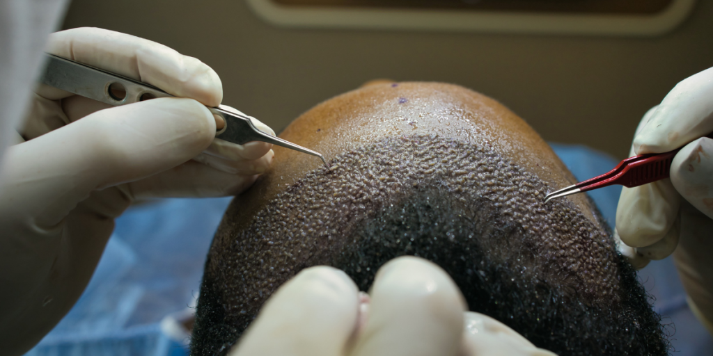 Hair Transplant in Chandigarh - N7 Aesthetics