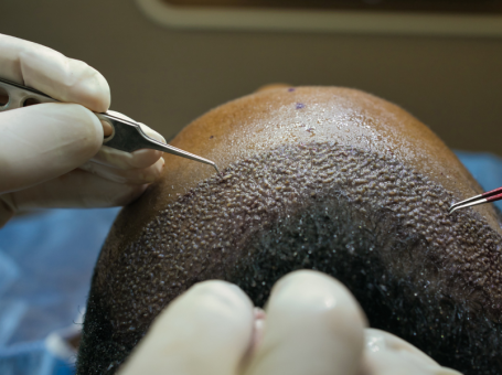 Hair Transplant in Chandigarh – N7 Aesthetics