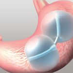 Gastric Balloon Melbourne - Complete Weight Loss Solution